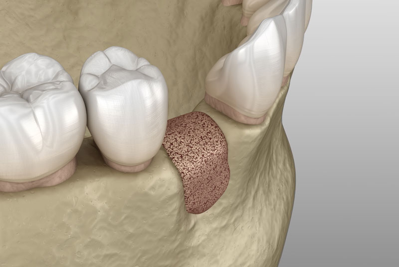 bone graft model