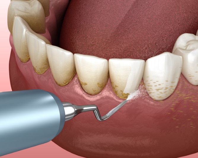 a dental performing periodontal maintenance on gum disease.