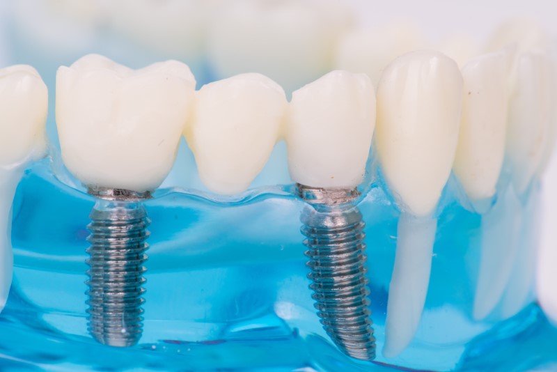 a dental implant model with two dental implant posts.