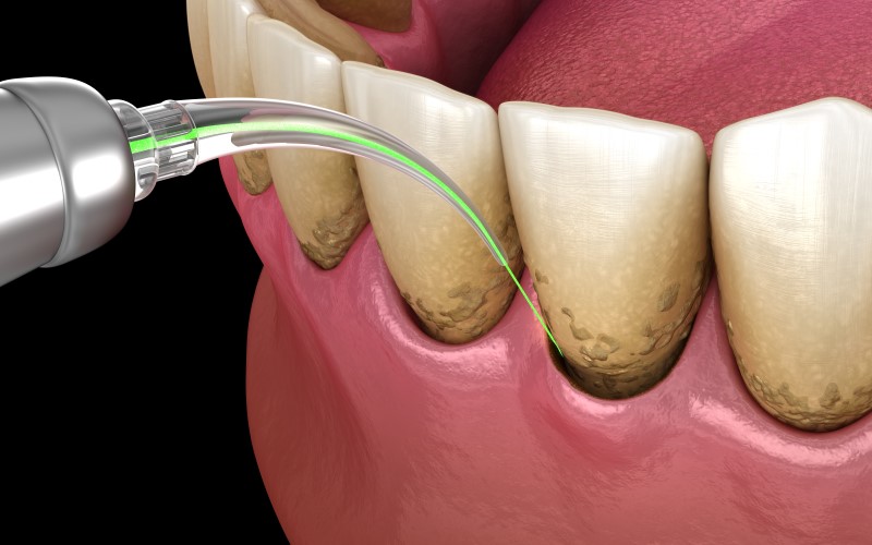 a dental laser treating gum disease.