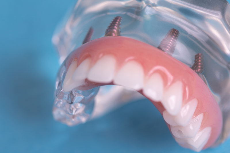a full arch dental implant model.