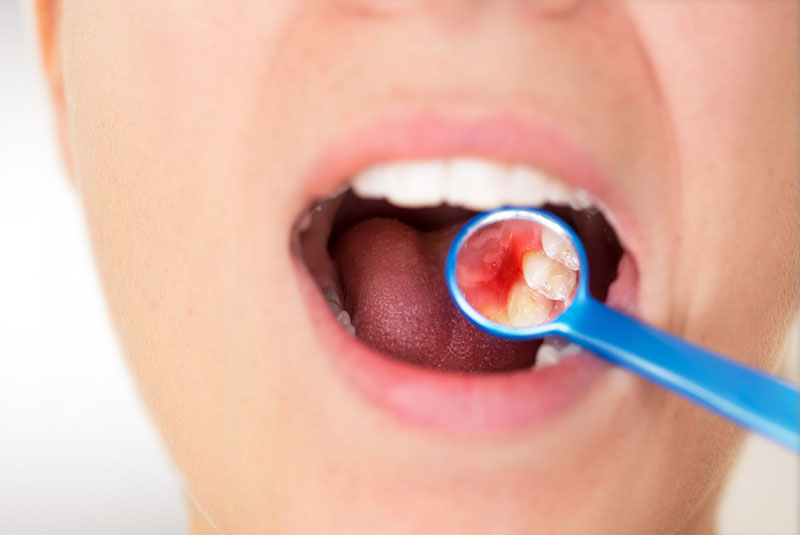 a dental patient needing periodontal treatment.