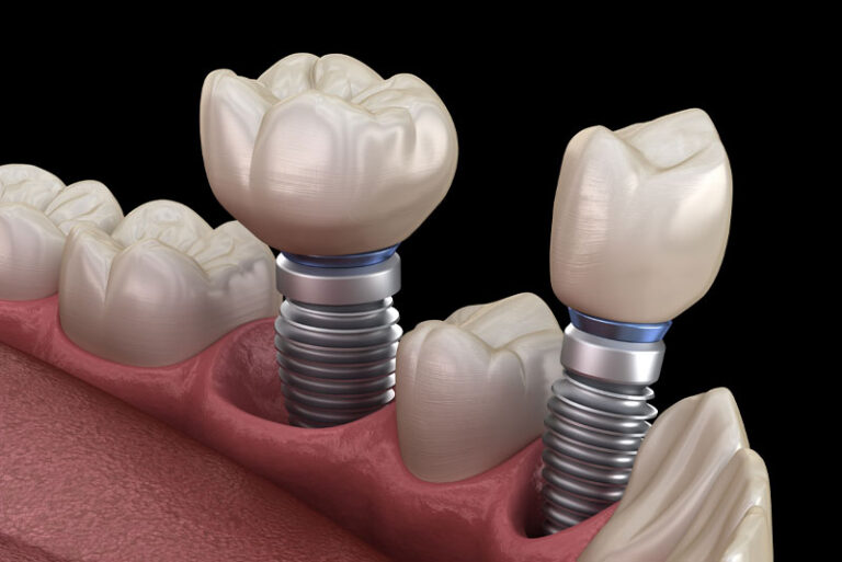 two dental implants with screwlike dental implant posts.