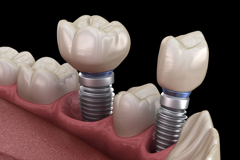 two dental implants with screwlike dental implant posts.