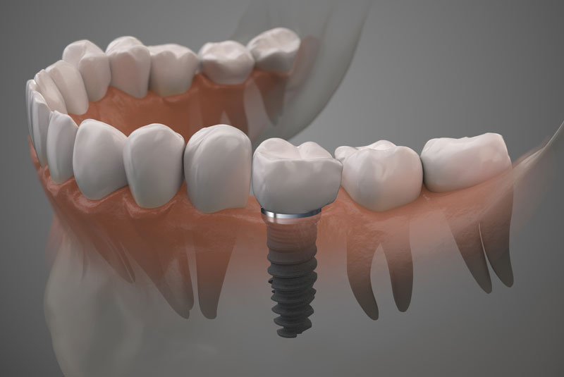 single dental implant post in a lower arch graphic.