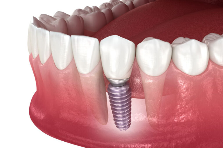 a single dental implant and post in a lower arch.