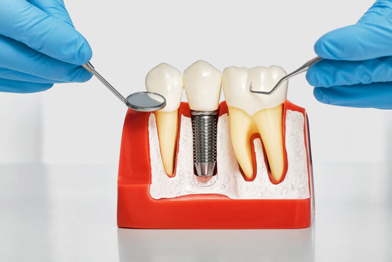 a dental implant model with a bone cutaway showing a dental implant post.