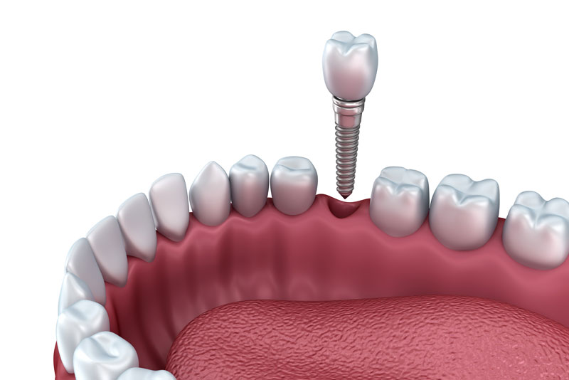 a dental implant being placed in a digital model