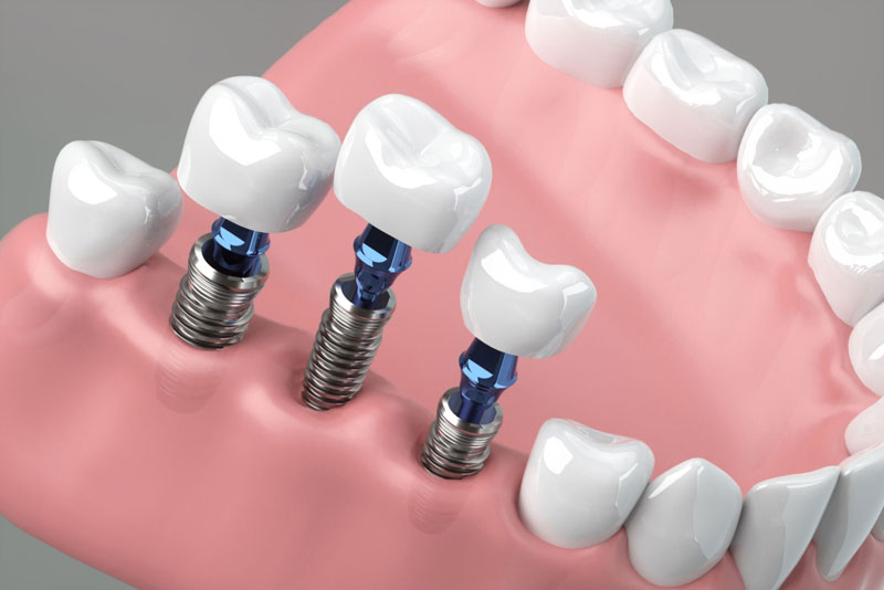three single dental implants and posts in a lower arch graphic.