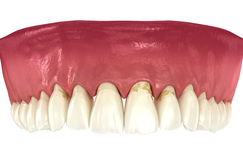 a full mouth dental model showing the effects of gingivitis.
