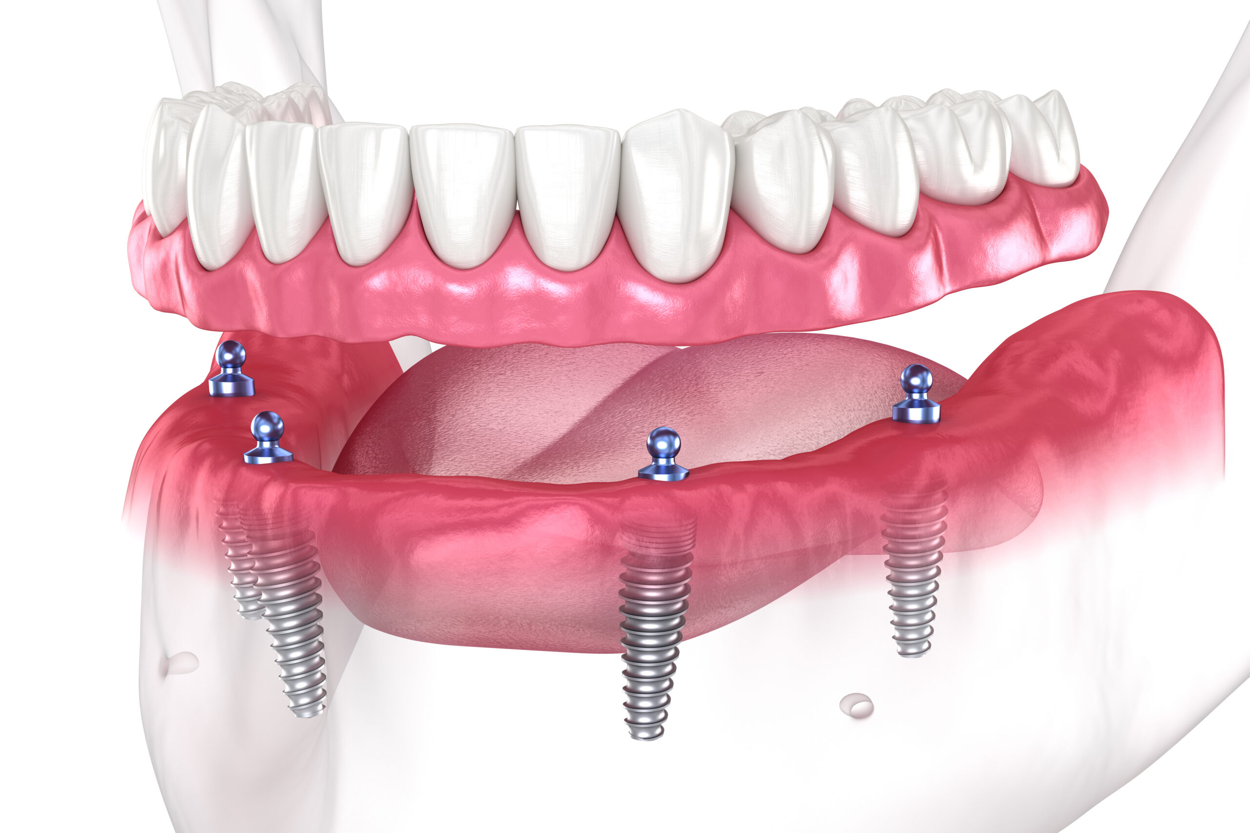 a full mouth dental implant graphic showing the implant posts in the jaw.