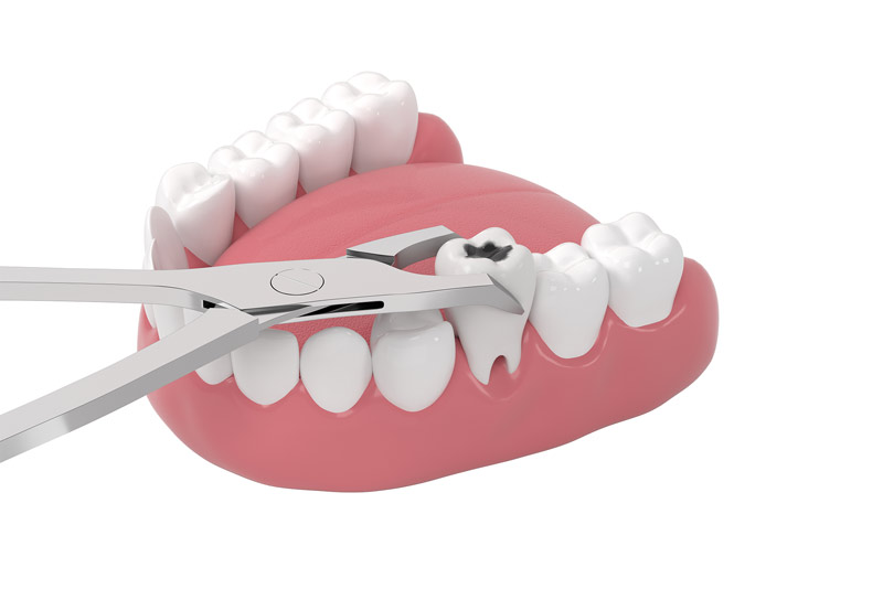 a digital model of a jaw with a tooth being extracted.