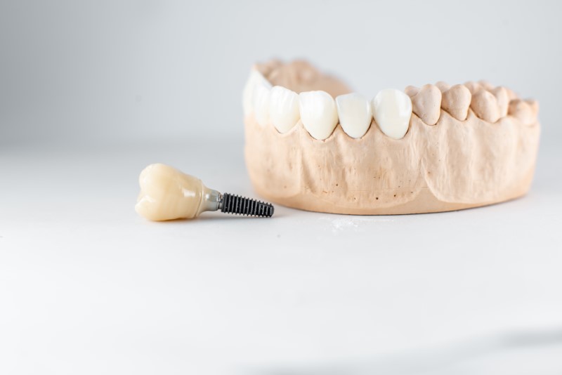 a model of an artificial jaw with multiple dental implants.