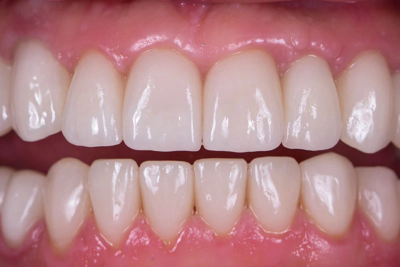 before and after dental implants