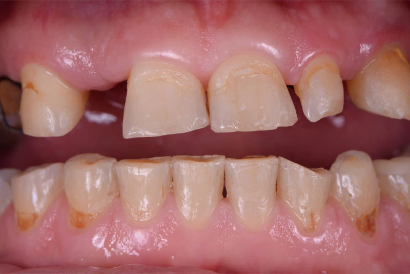 before and after dental implants