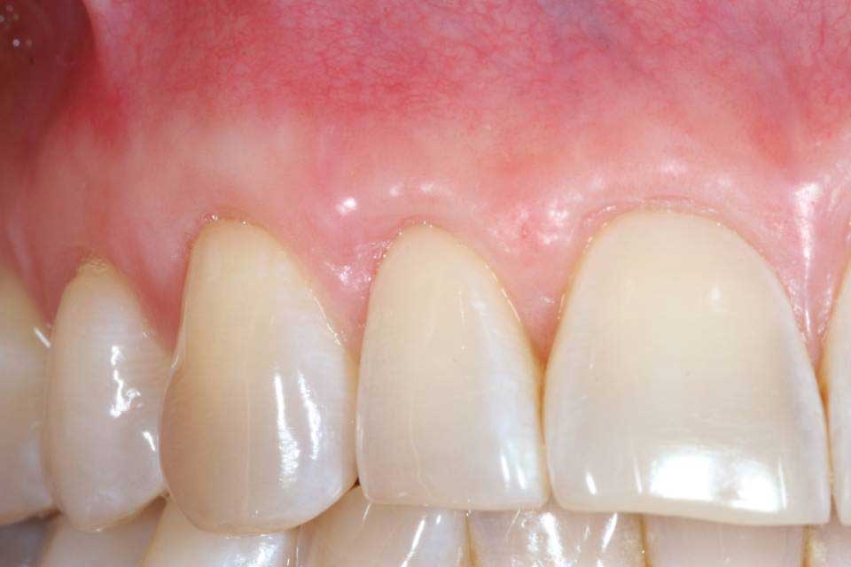 Before and after periodontal treatment