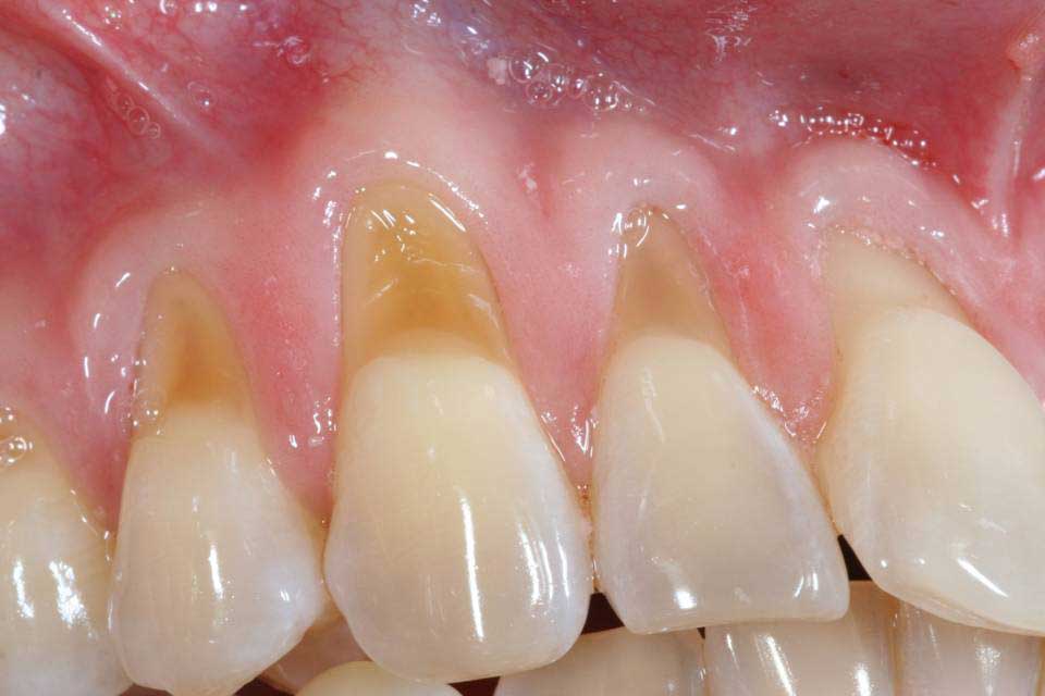 Before and after periodontal treatment