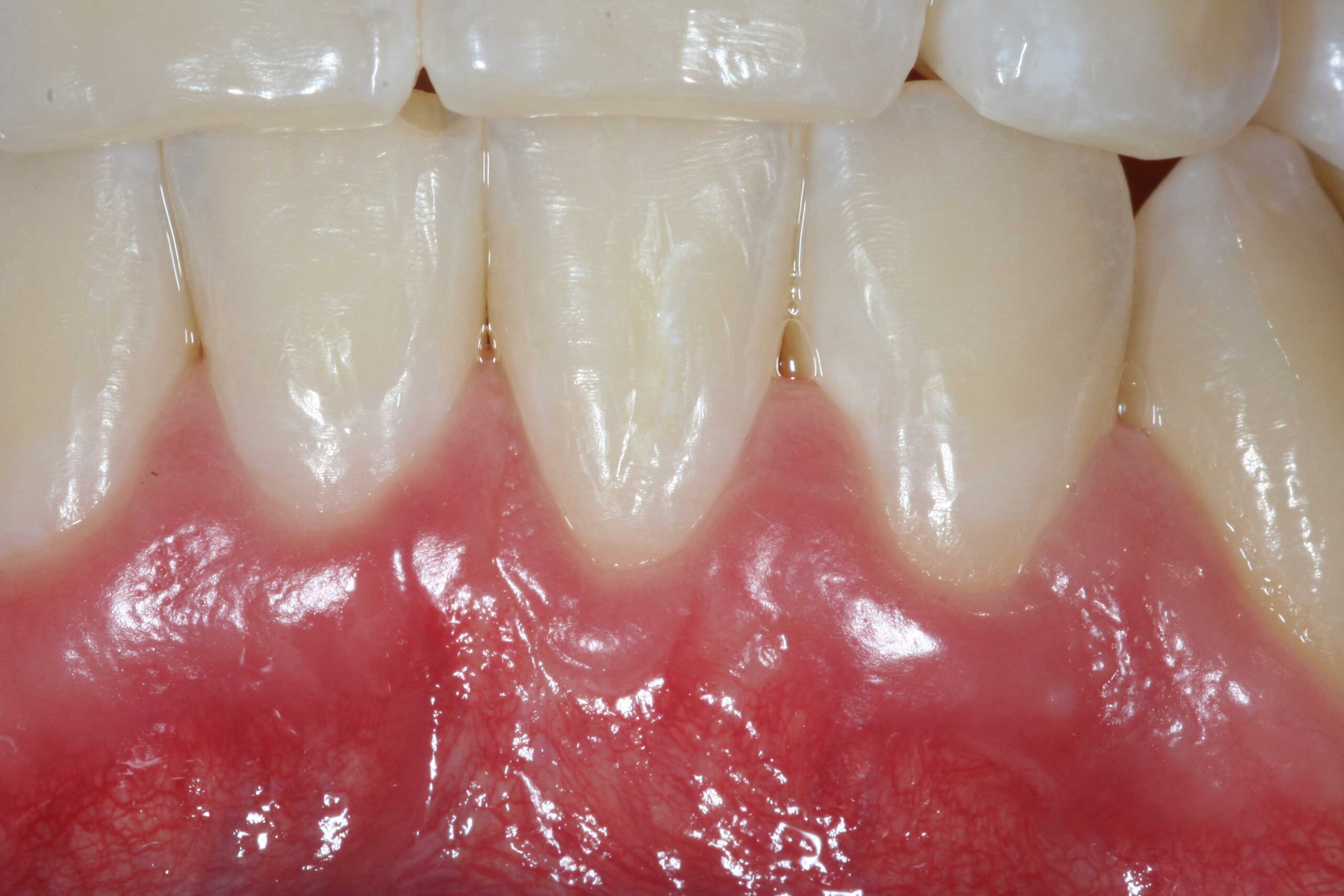 Before and after periodontal treatment