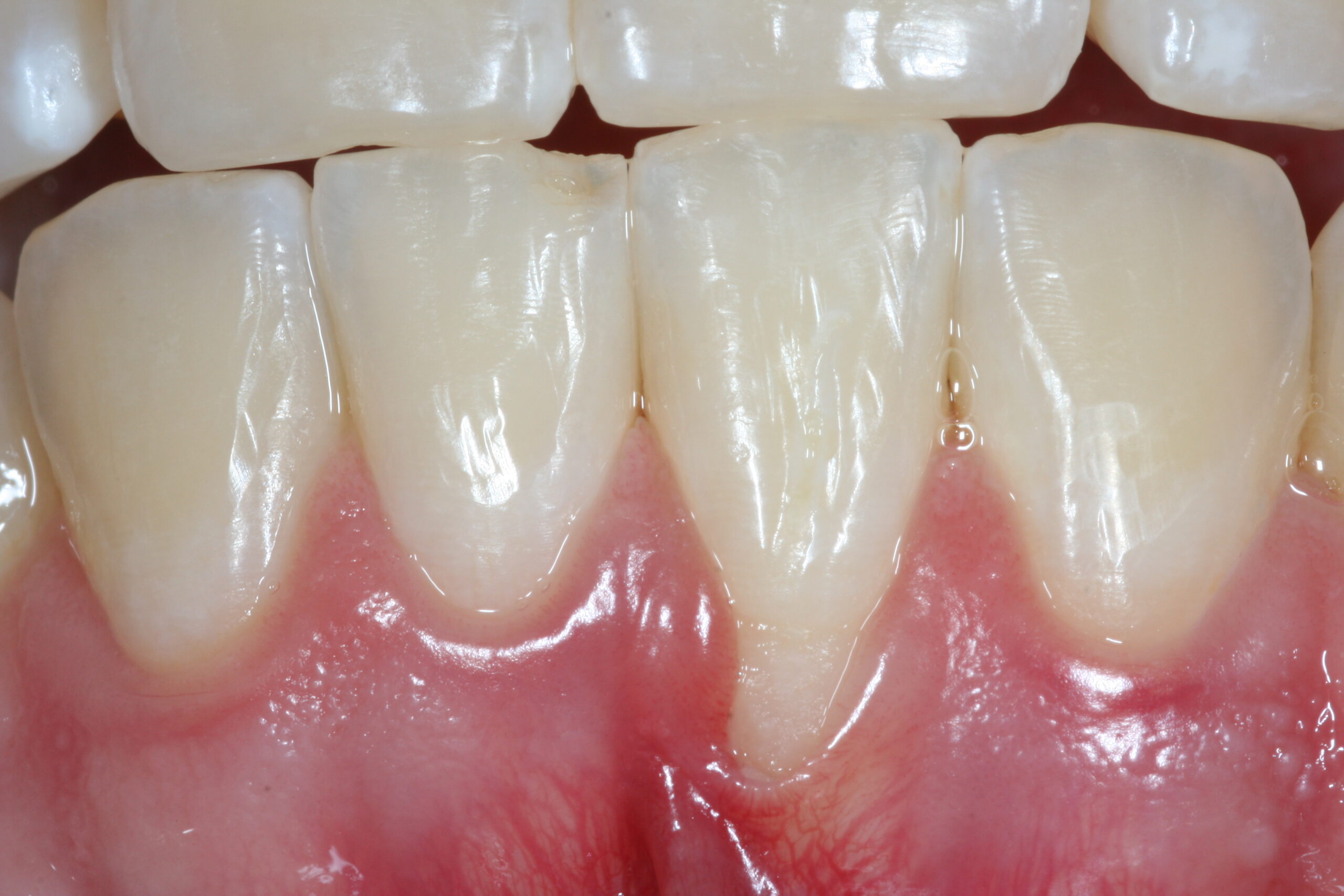 Before and after periodontal treatment