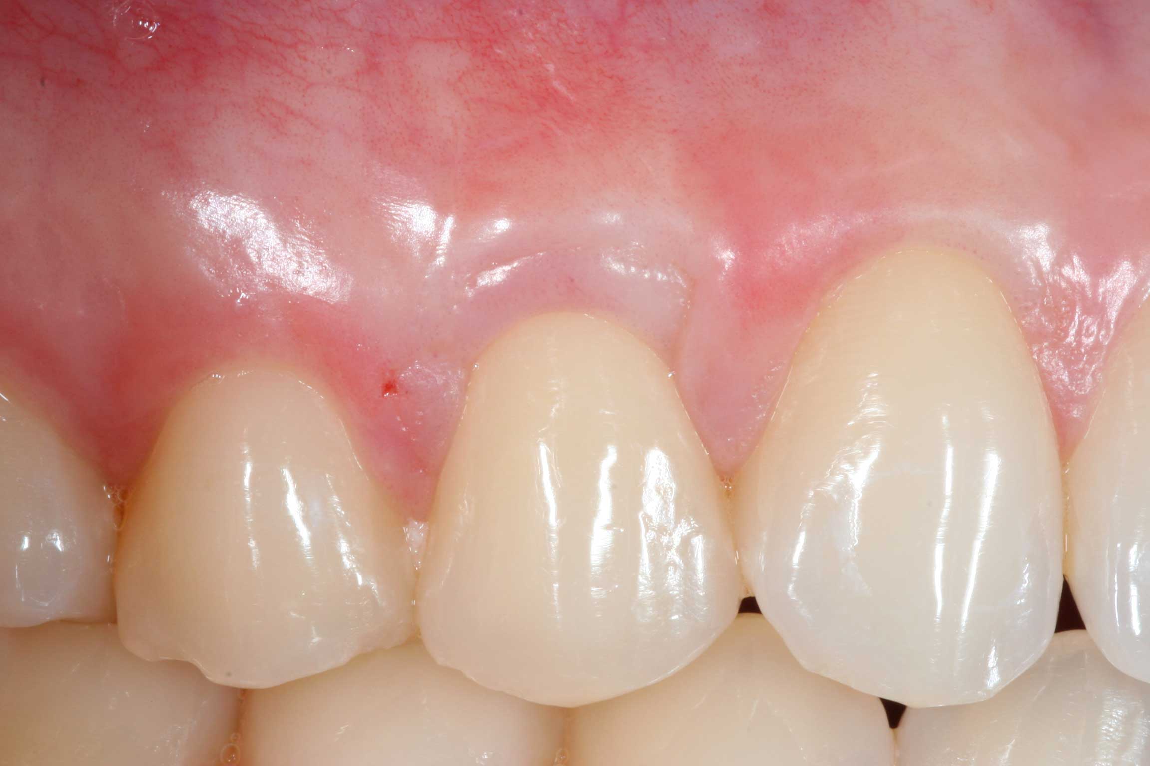 Before and after periodontal treatment