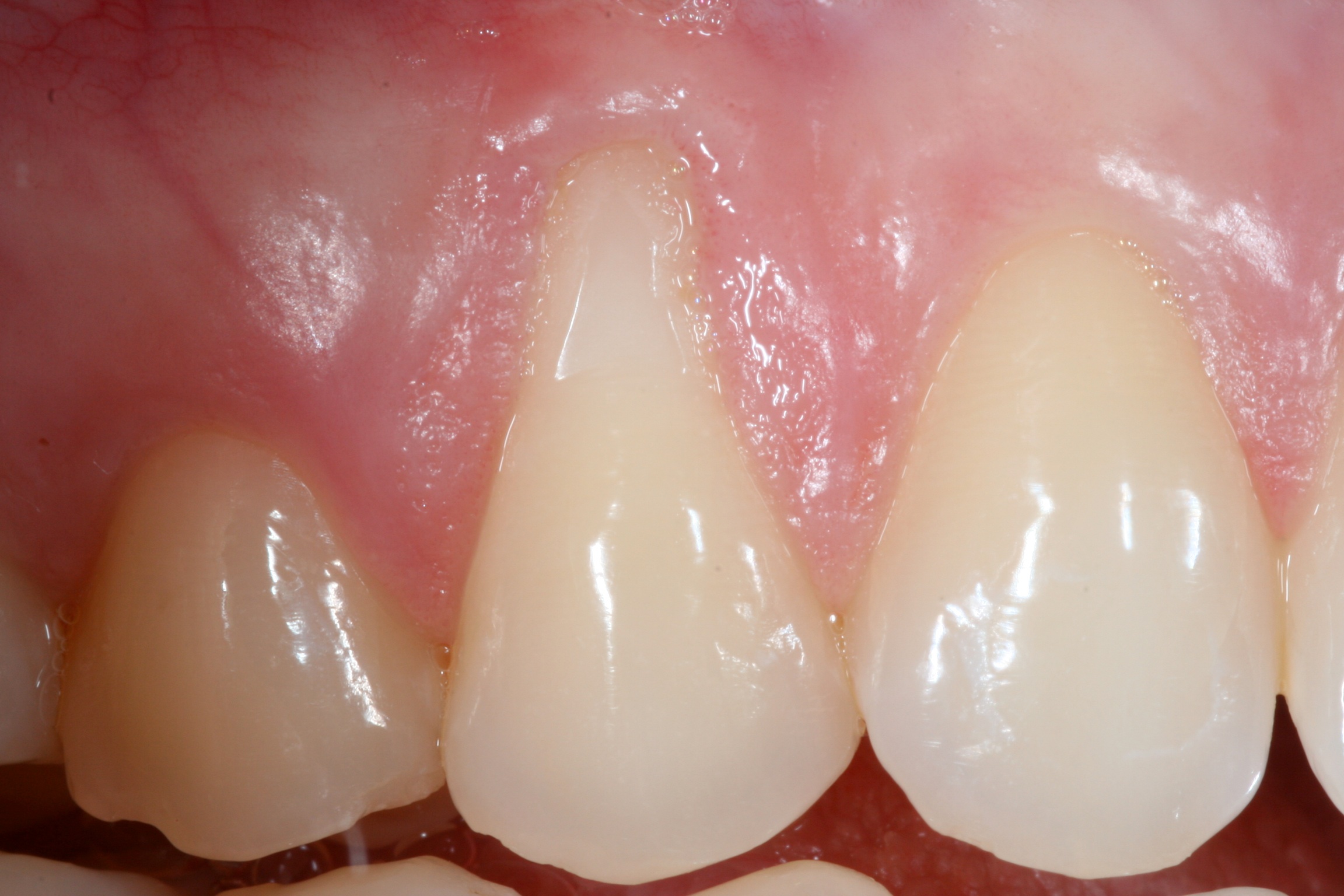 Before and after periodontal treatment