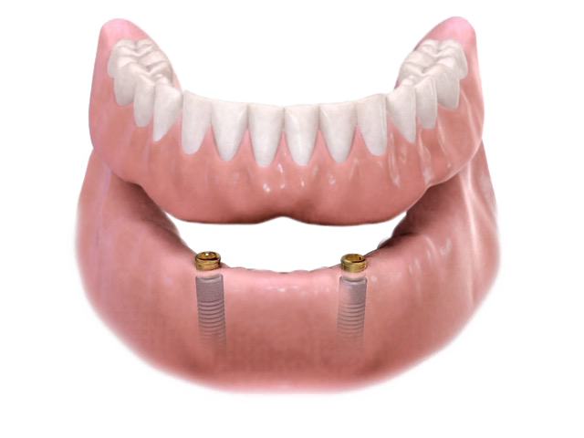 overdenture model