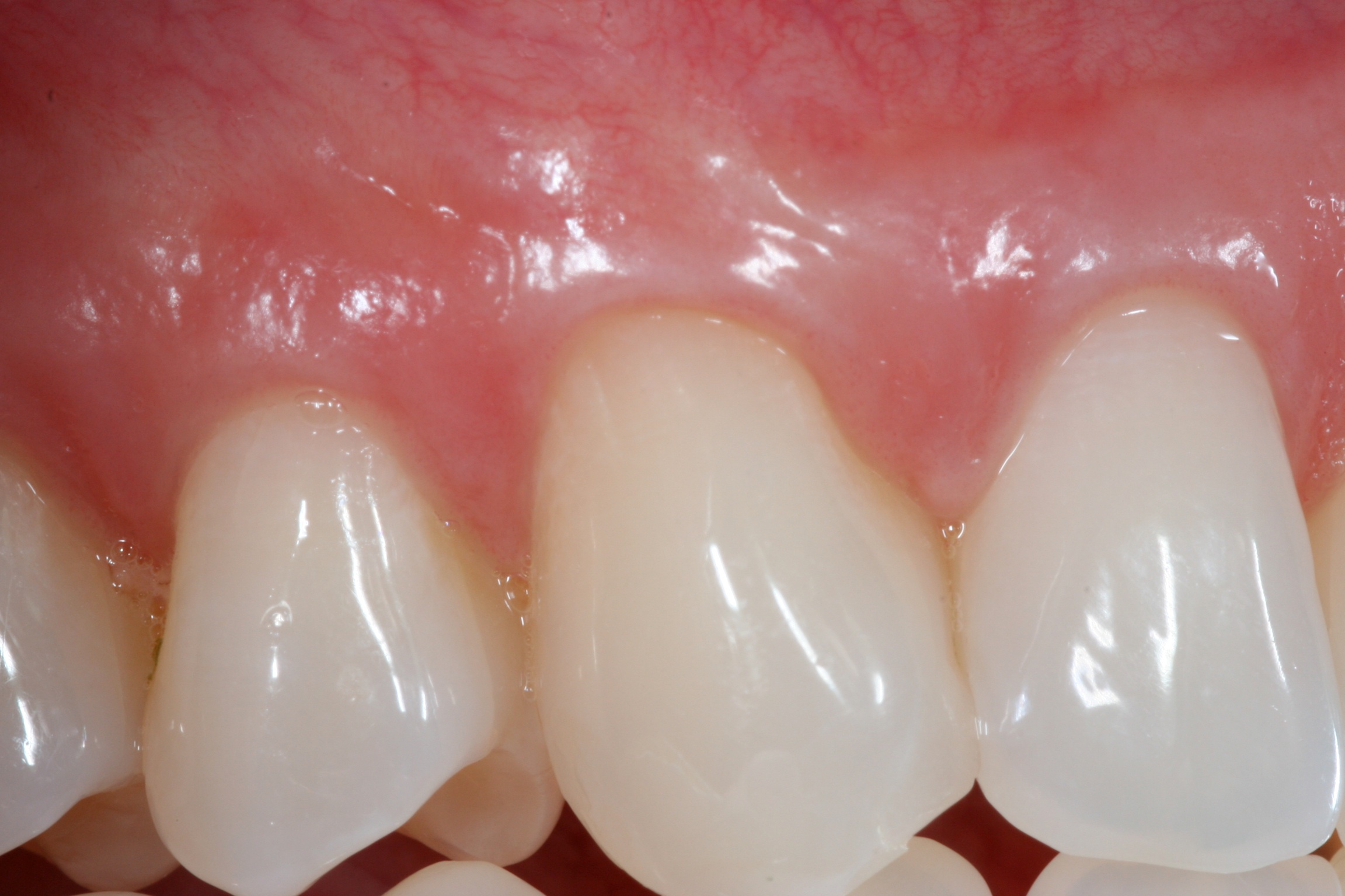 Before and after periodontal treatment