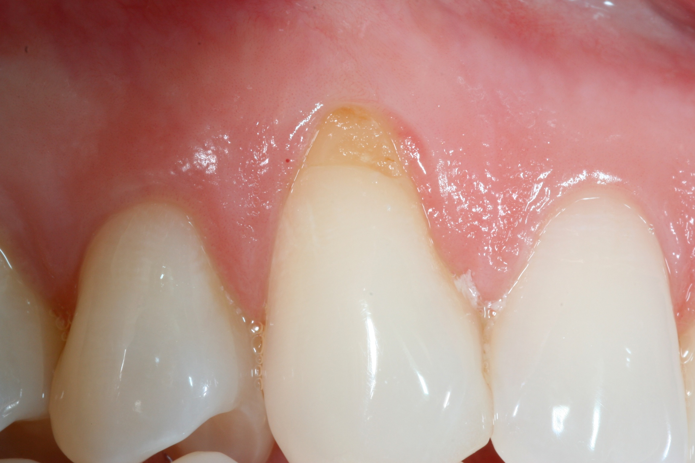 Before and after periodontal treatment