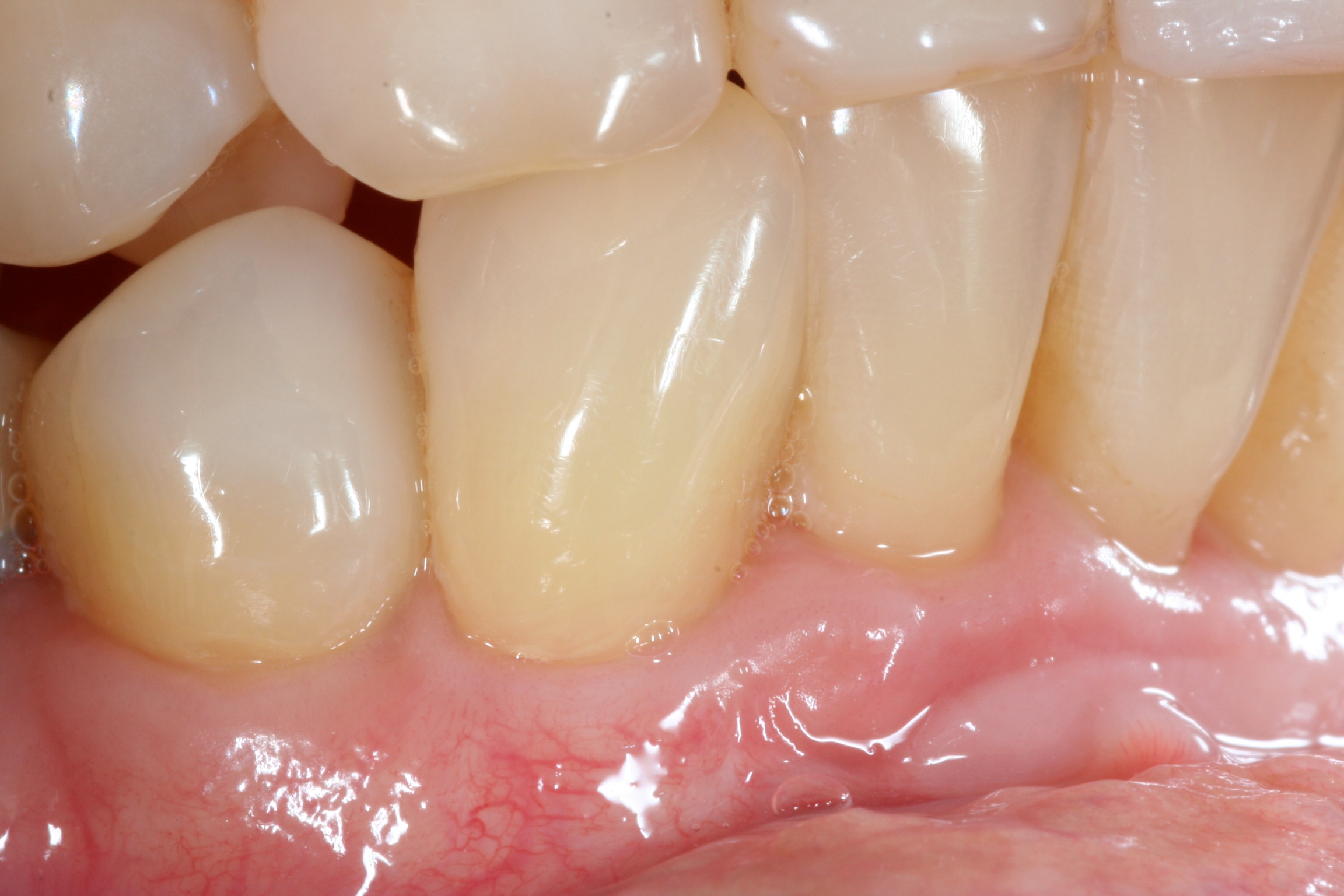 Before and after periodontal treatment