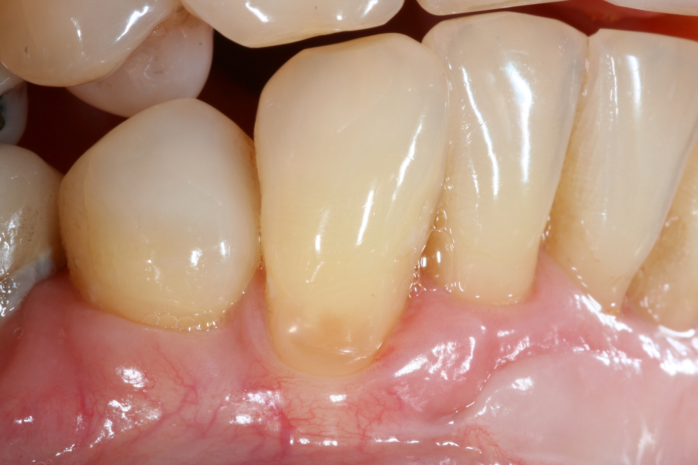 Before and after periodontal treatment