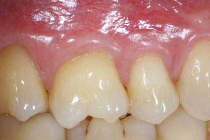 Before and after periodontal treatment