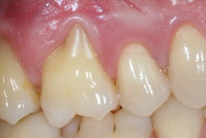 Before and after periodontal treatment