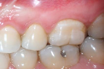 Before and after periodontal treatment