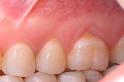 Before and after periodontal treatment