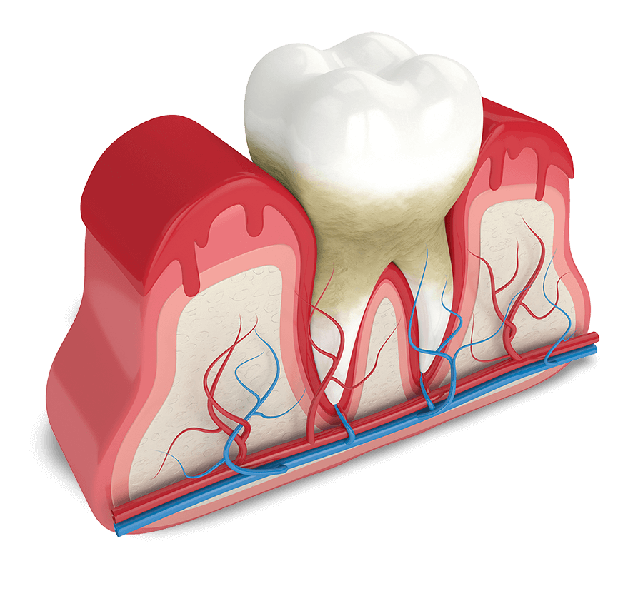 periodontal disease model