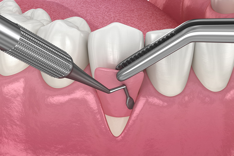 Gum Recession: Soft tissue graft surgery