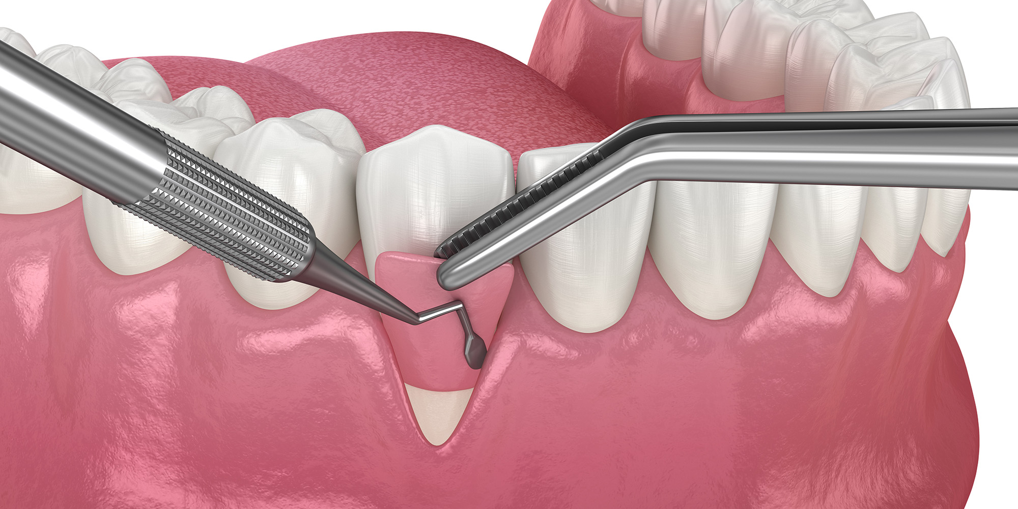 Gum Recession: Soft tissue graft surgery