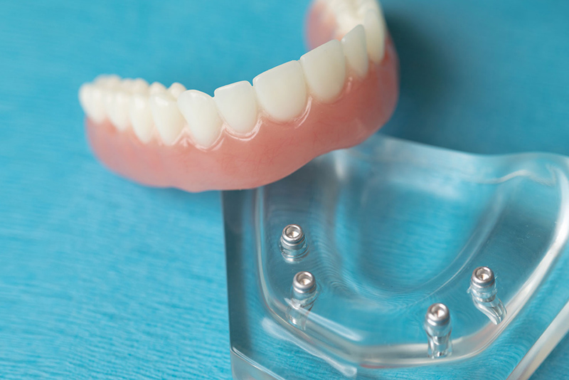 all-on-4-implant-supported-dentures