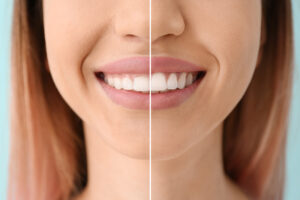 Young woman before and after procedure of gingival plasty