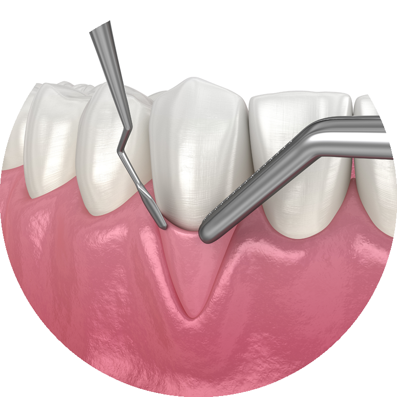 Gum Recession: Soft tissue graft surgery