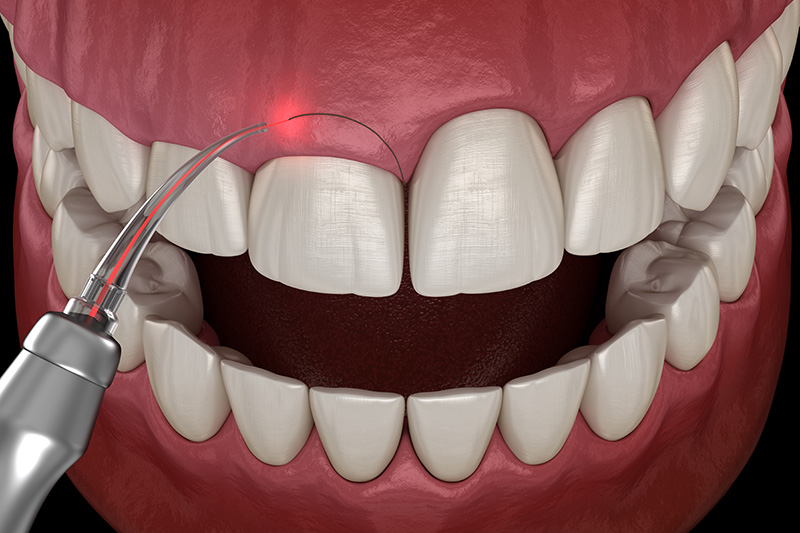 Gingivectomy surgery with laser using