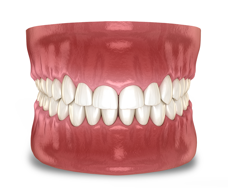 crown lengthening model