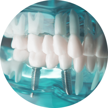 dental-implant-model