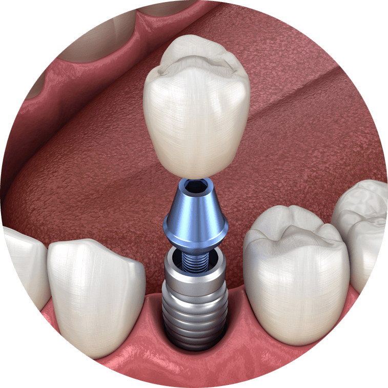 dental-implants-model