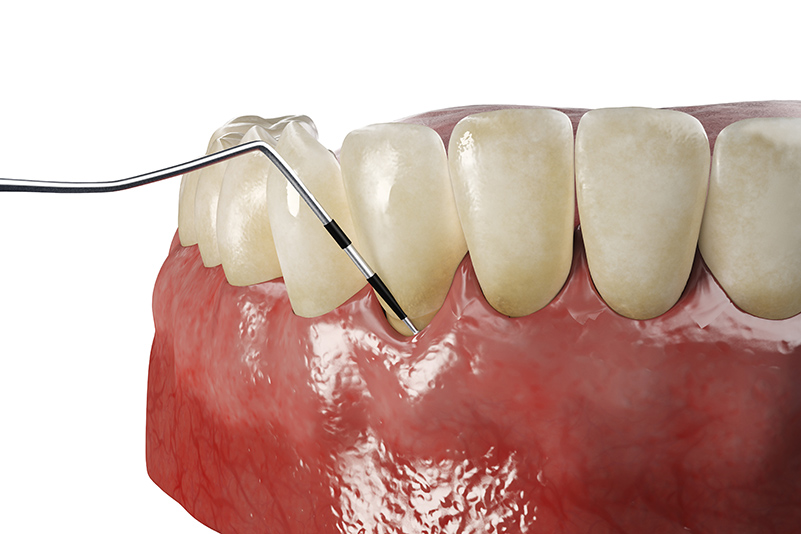 3d rendered illustration of periodontitis testing