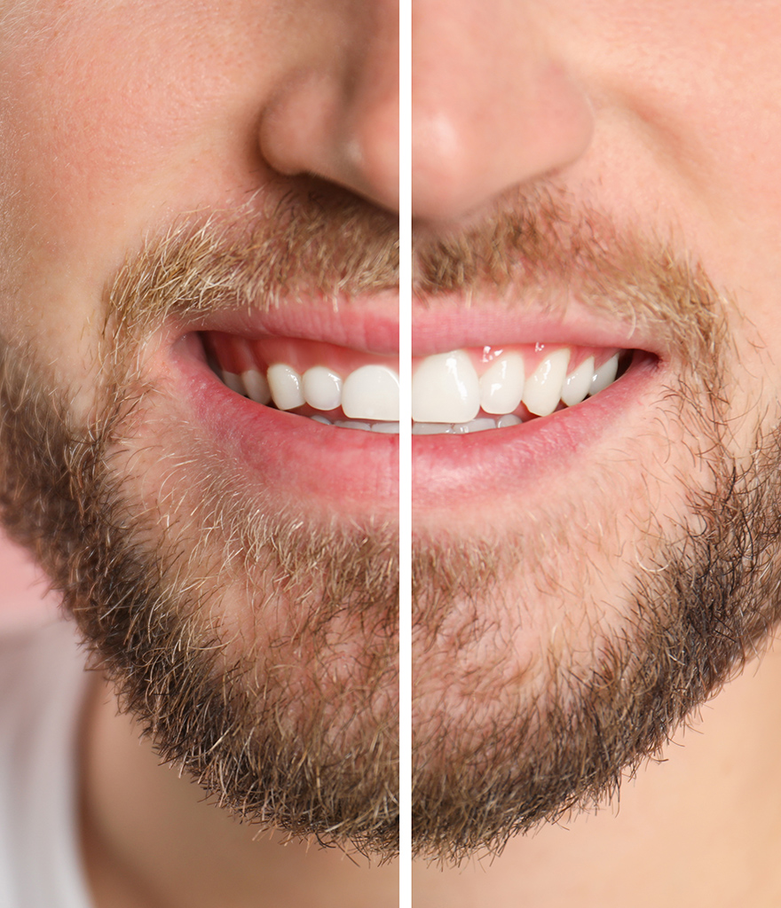 gingivectomy before and after
