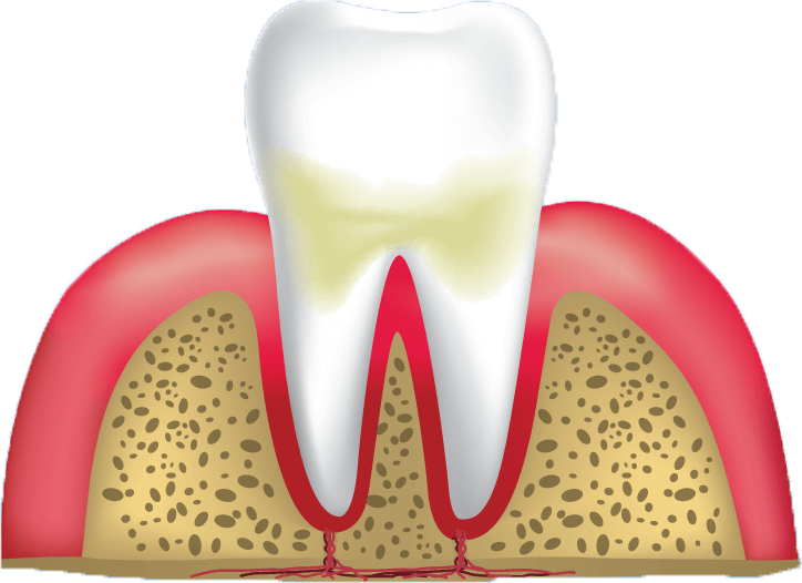 gum-disease-stage