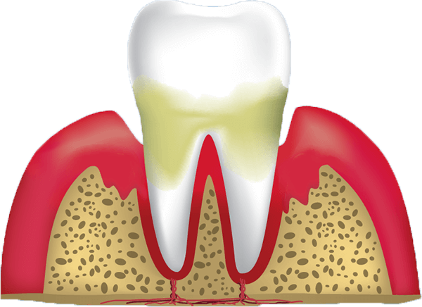 gum-disease-stage