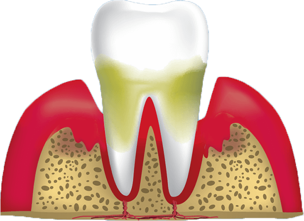 gum-disease-stage