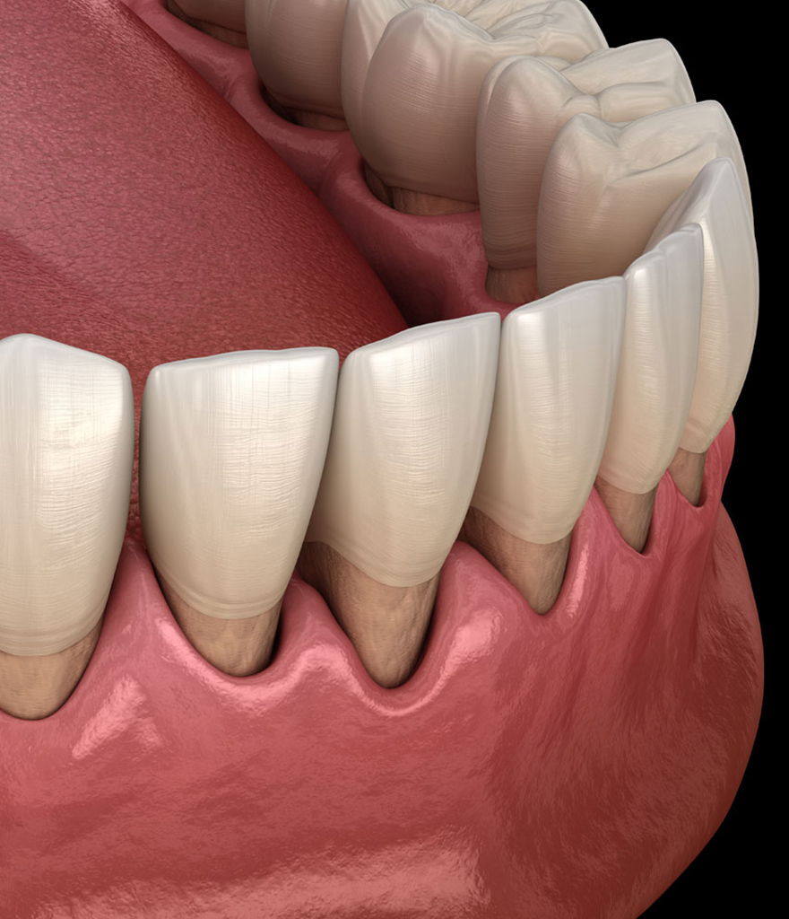 gum recession model